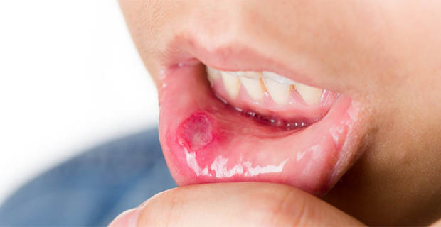 Berikut 7 Cara Mudah Untuk Menyembuhkan Sariawan