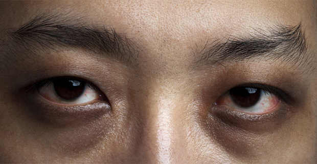 Inilah Penyebab Kenapa Muncul Lingkaran Gelap Yang Ada di Bawah Mata