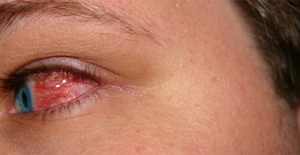 Begini Cara Mengatasi Mata Perih Karena Cipratan Cabai