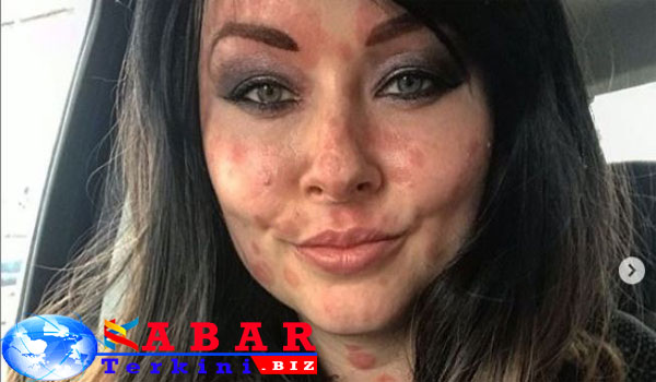Gara-Gara Ciuman, Wanita Ini Kena Penyakit Kulit yang Tak Bisa Disembuhkan